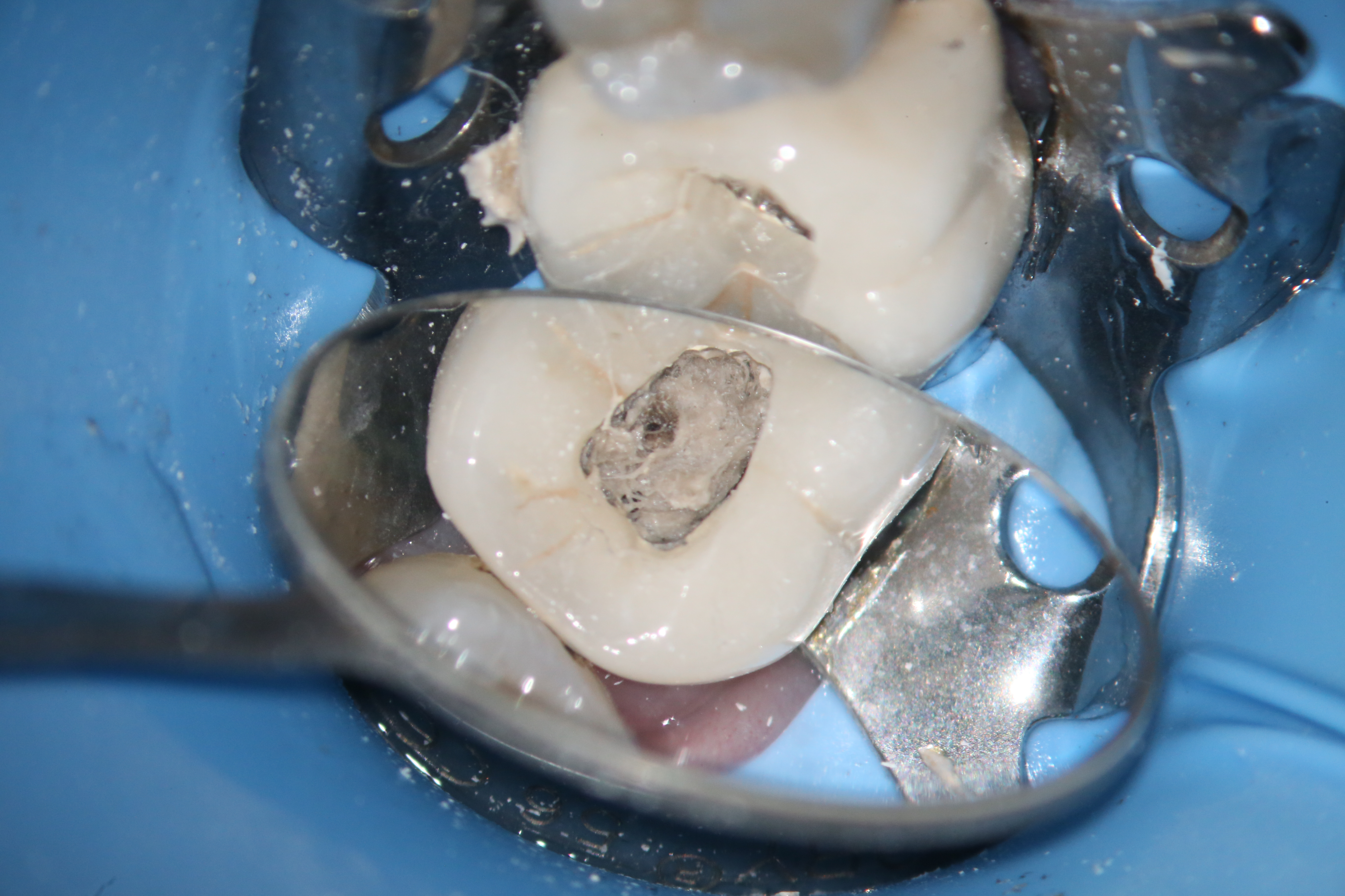 Tooth Replica Photographs Courtesy: Vu Le, D.D.S. 