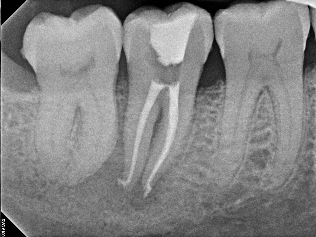 Sanjiz Kapur(NoHandFiles)_Post-op1_