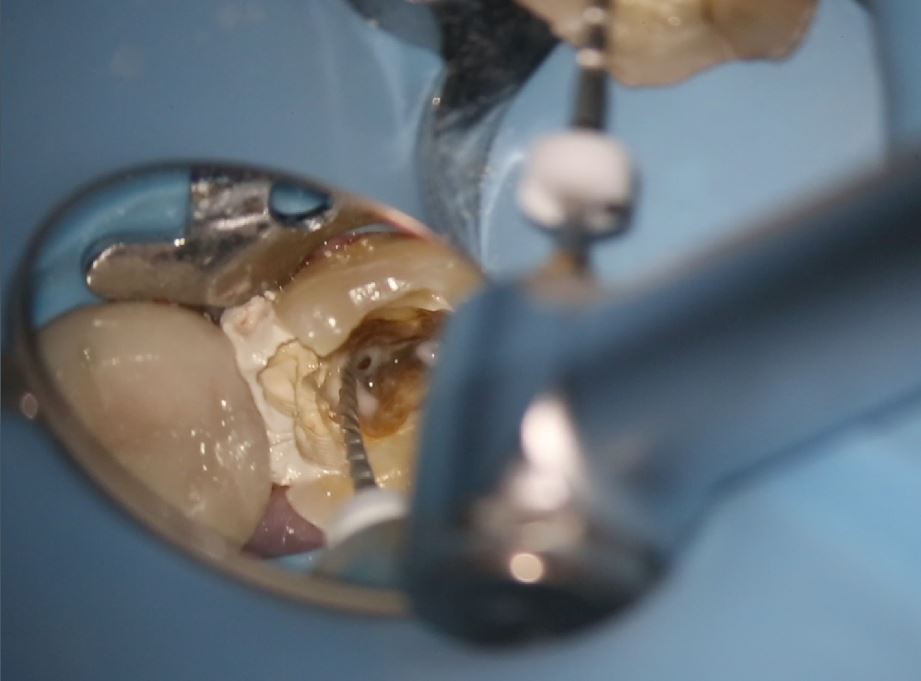 Member Videos - Root Canal Academy