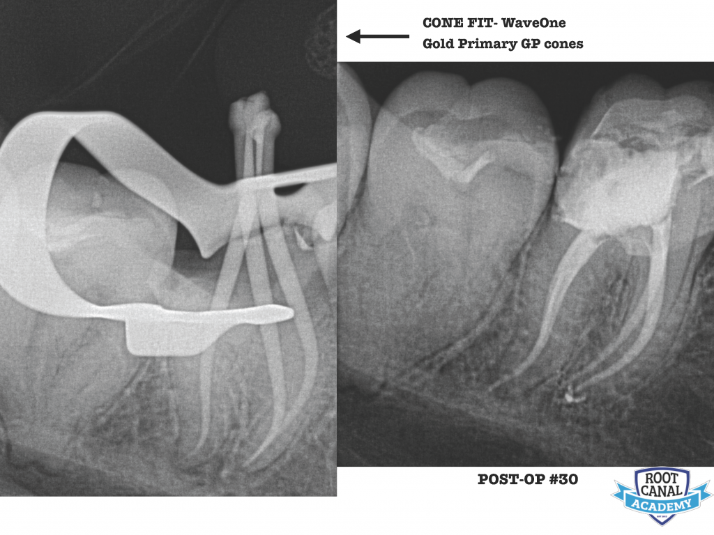 Learning Lessons Case 3 "Shaping" Root Canal Academy