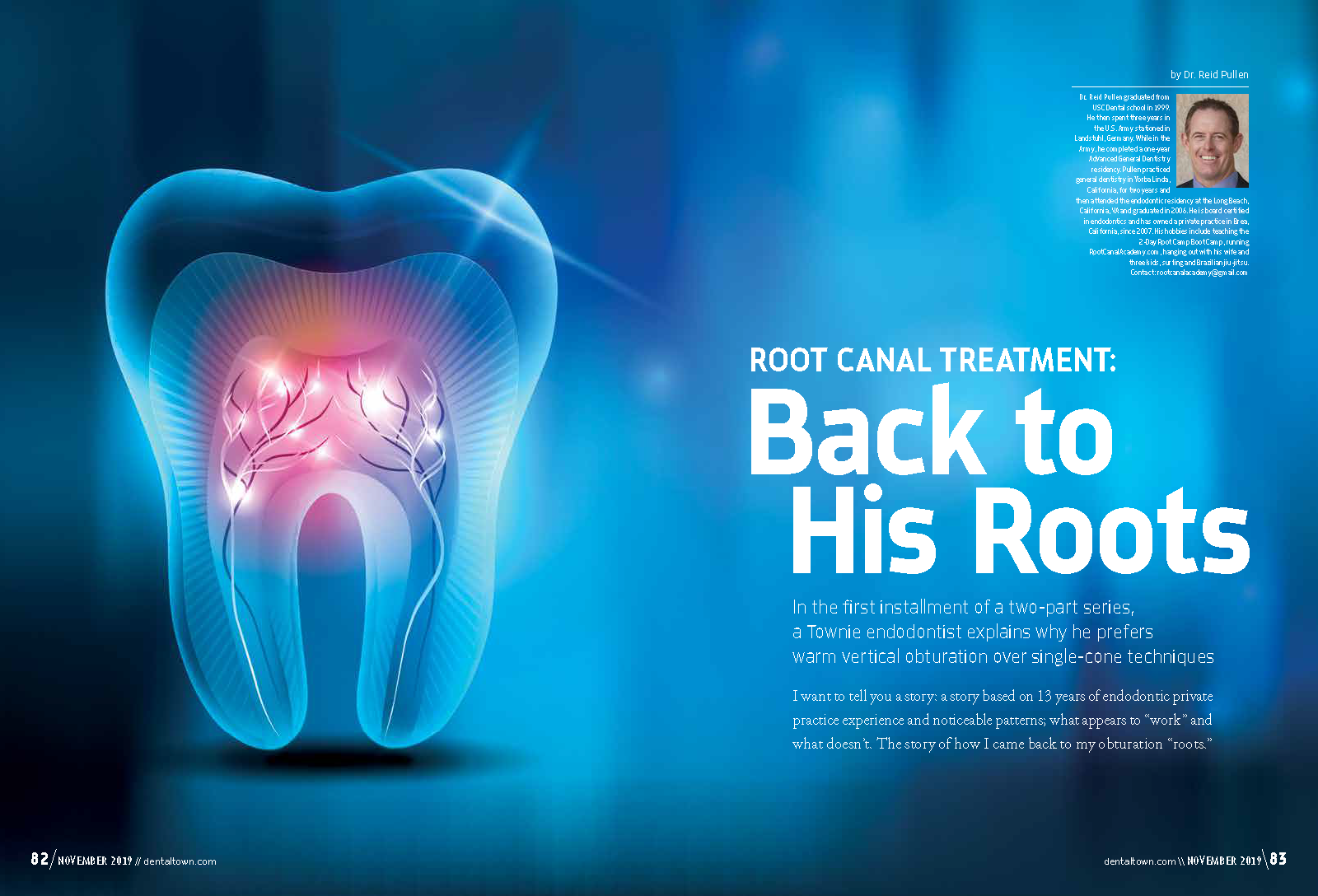 why-i-prefer-warm-vertical-obturation-over-single-cone-root-canal